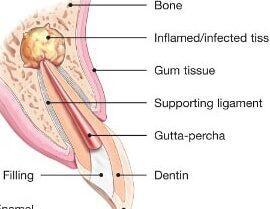 Tanden Tips - Endodontie Procedure