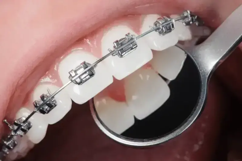Tanden Tips - Orthodontie Kinderen