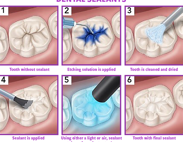 Tanden Tips - Sealants bij Kinderen