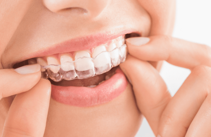 Tanden Tips - Orthodontie Kinderen