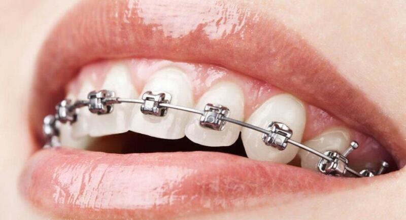 Tanden Tips - Metalen Beugels