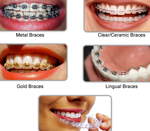 Tanden Tips - Metalen Beugels