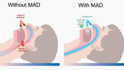 Tanden Tips - Anti-Snurk Beugel