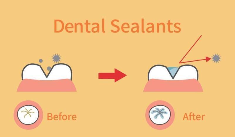 Tanden Tips - Sealants bij Kinderen