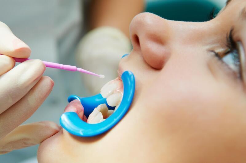 Tanden Tips - Sealants bij Kinderen