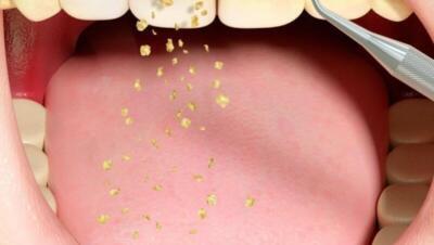 Tanden Tips - Retainer