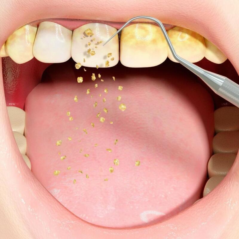 Tanden Tips - Retainer