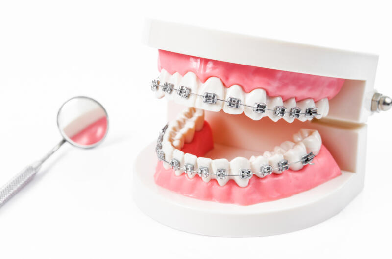Tanden Tips - Metalen Beugels