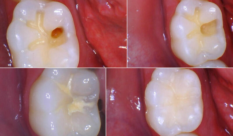Tanden Tips - Sealants bij Kinderen