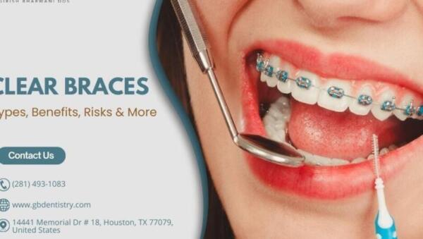 Tanden Tips - Transparante Beugels