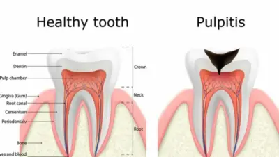 Tanden Tips - Wortelpuntontsteking